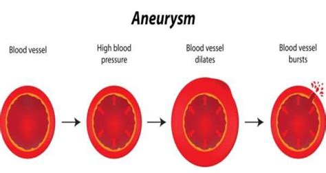 Aneurysm and Health - Health Tips, Aneurysm and Health Articles and ...