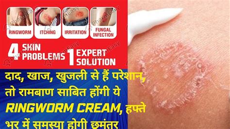 दाद खाजखुजली से हैं परेशान तो रामबाण साबित होंगी ये Ringworm Cream