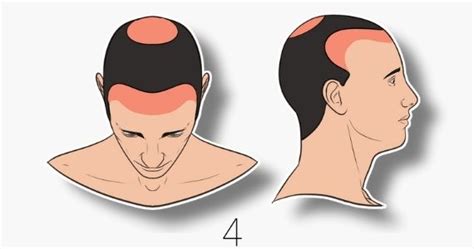 Hair Transplant For Receding Hairline Norwood Scale