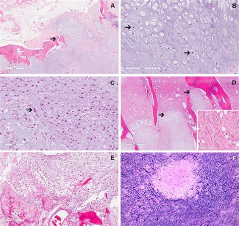 Histologic Features And Variants Of Chondrosarcoma A Cortical Breach