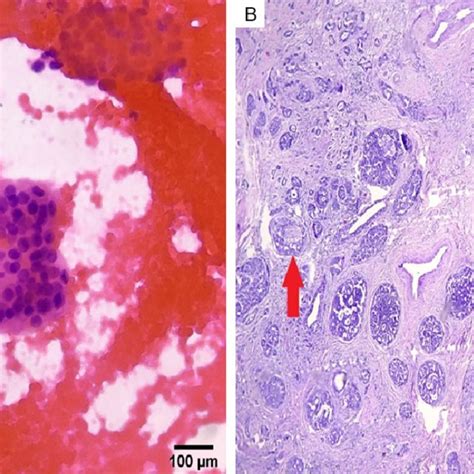 Cytologic A And Histologic B Findings Of A Basal Cell Adenoma Case