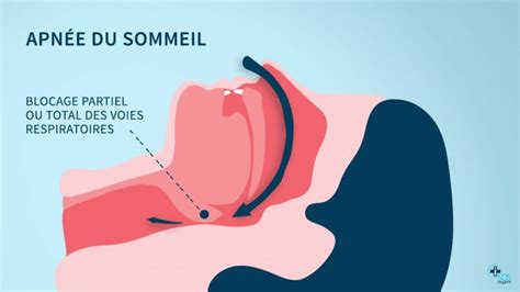 Le syndrome dapnées obstructives du sommeil le trouble le plus