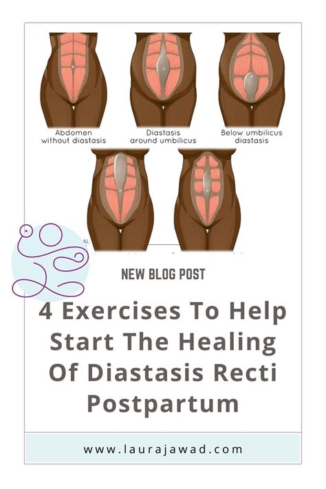 The Real Deal With Diastasis Recti What It Is Why It S A Problem And