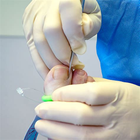 Ingrown Toenail The Foot Force Podiatry