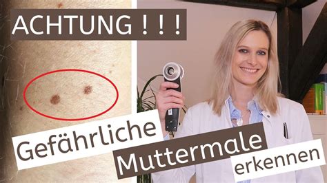 Gef Hrliche Muttermale Hautkrebs Derma Quick Tipp