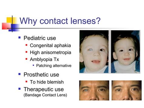 Role of bandage contact lens in corneal wound healing | PPT