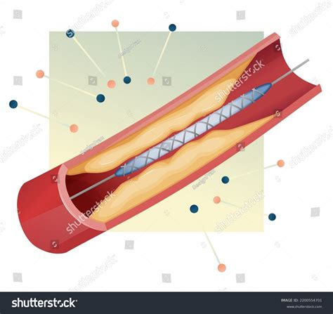 Heart Stent Procedure Stock Illustration Eps Stock Vector (Royalty Free ...