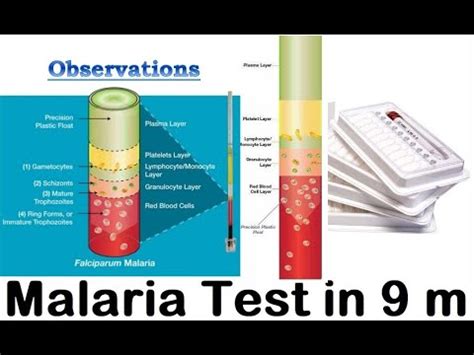 Quantitative Buffy Coat QBC Test For Malaria YouTube