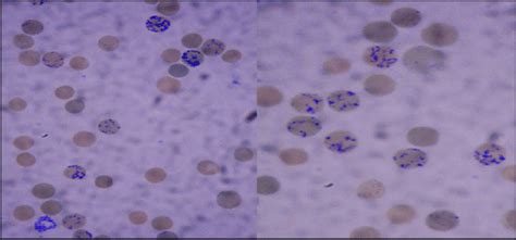 A B Reticulocytes Shown On Supra Vital Stain After C