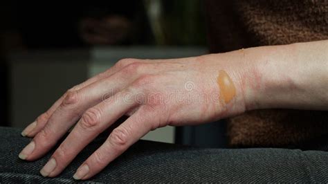 Close Up Of A Woman S Hand With A Blister From A Boiled Water Burn