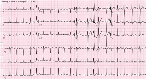 Atrial Fibrillation — HoldingOrders.com