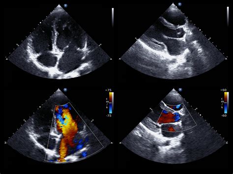 Echocardiogram – iHealth Centre Brampton Vaughan Rexdale Malton