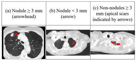 Electronics Free Full Text Lung Nodule Classification Using Taguchi