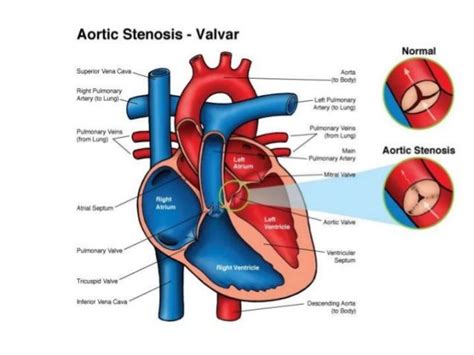 Right Ventricular Outflow Tract Obstruction