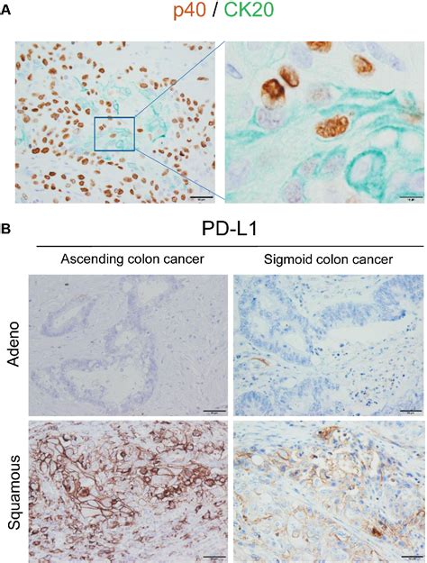 Figure 1 From A Case Report Of Metachronous Multiple Adenosquamous