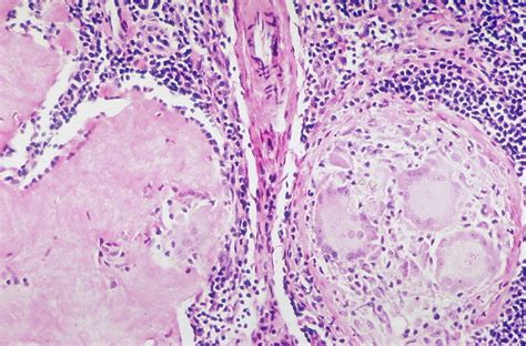 Flickriver Photoset Sarcoidosis Fibrosis Of Granulomas