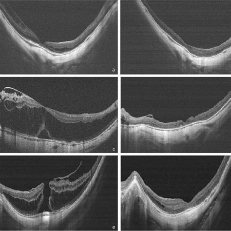 Representative Optical Coherence Tomography Scans Of The Three Download Scientific Diagram