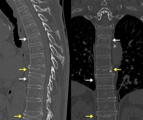 Acute And Chronic Vertebral Compression Fractures Radiology Case