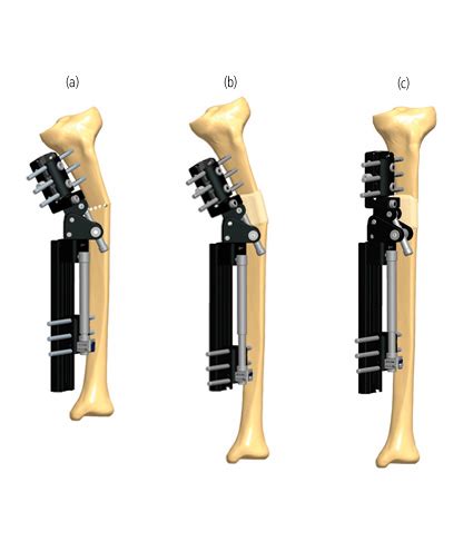 Correction Of Tibial Deformity With Lengthening Orthofix ABS