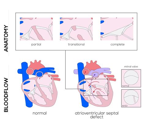 Congenital Defects Tutorial Congenital Heart Defects Atlas Of Human