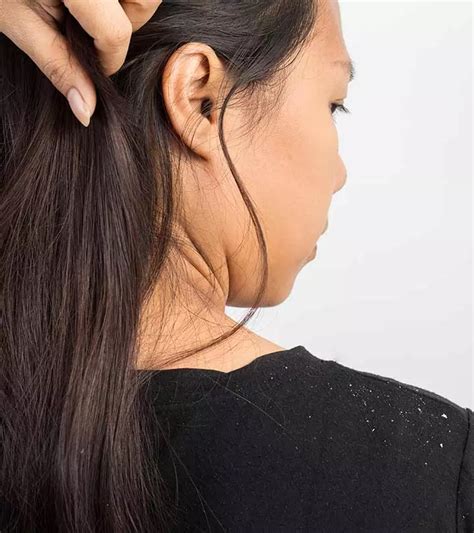 Dandruff In Winter Ways To Prevent It Naturally