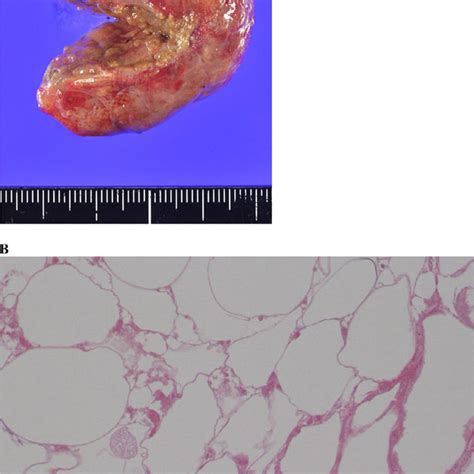 A Macroscopic Pathological Finding Tumor With The Degenerated Fatty