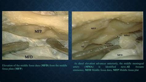 Facial Nerve Decompression