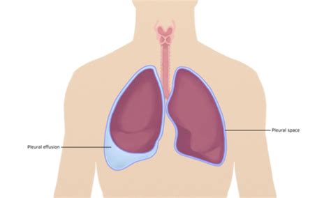 Pleural Effusion Flashcards Quizlet