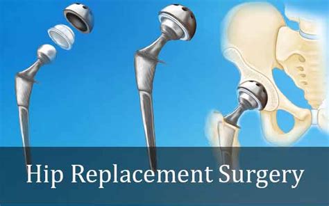 Hip Replacement Surgery and Things You Should Know - Sioux Falls Orthopedics