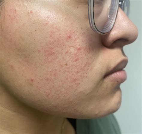 Red Raised Bumps On Face Dry Skin Help Rskin