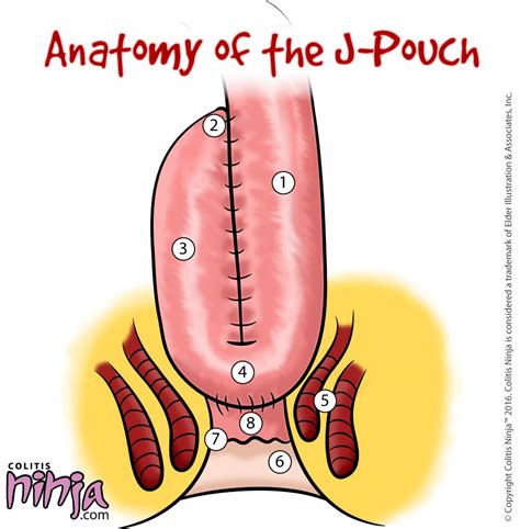 J Pouch Important Things You Need To Know Infographics