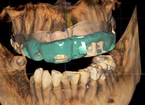 Digitally Guided Implant Surgery Silver Oaks Dental Clinic