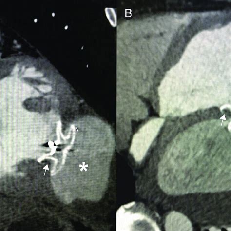 A And B Cardiac Computed Tomography Performed After Six Months