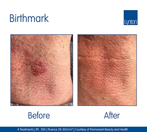 Birthmark Removal Before And After