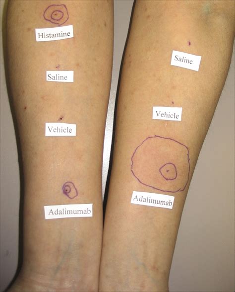 Immediate Type I Hypersensitivity Response Implicated In Worsening