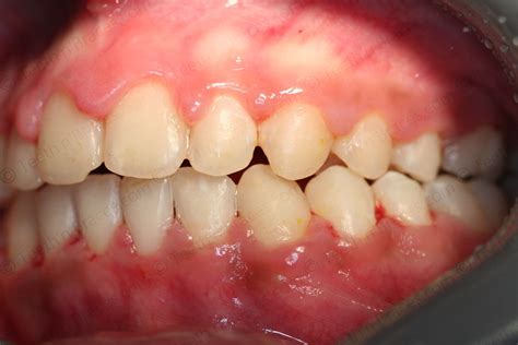 Case 36: Protruded anterior Teeth | Teeth N Braces