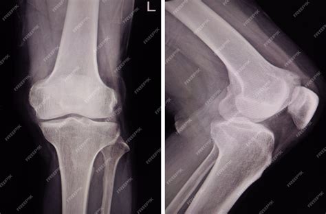 Premium Photo | X-ray picture showing knee joints