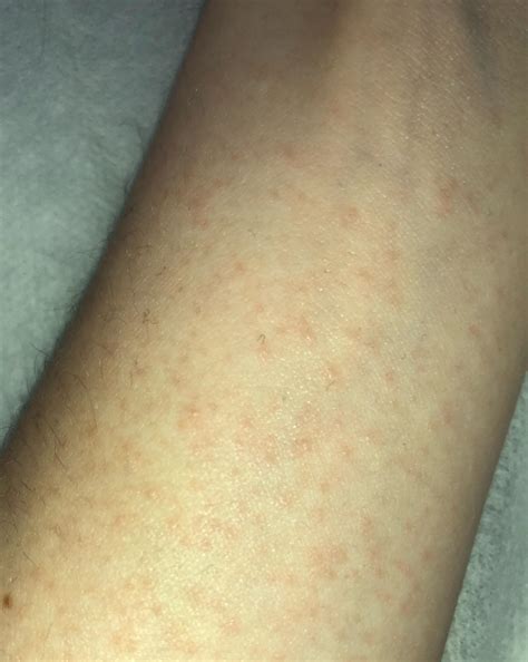 Whats This Rash Rmedicaladvice