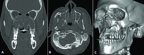 Case 1 -Computed tomography scan showing the Le Fort I fracture: (A)... | Download Scientific ...