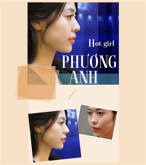 Hot girl Phương anh và hành trình thăng hạng nhan sắc nhờ Nâng mũi thẩm mỹ