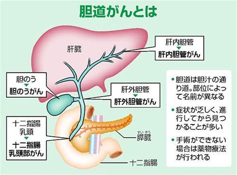 982 癌治療 胆道がん治療、選択肢広がる！抗がん剤3剤の同時投与も有効！ 難病末期癌からの生還！～余命3ヶ月のステージ4・末期癌を完治