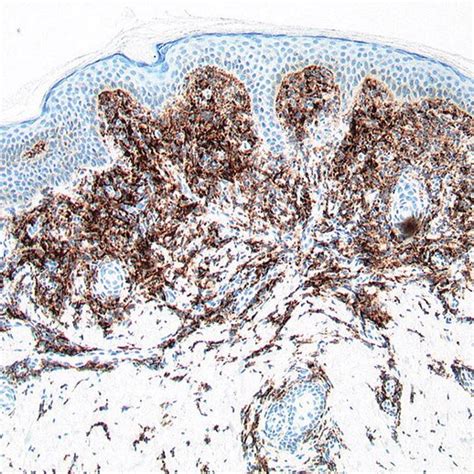 A Multiple Yellow Brownish Papules On The Cheeks B Papules Download Scientific Diagram