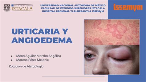 Urticaria y angioedema Angélica Mena uDocz