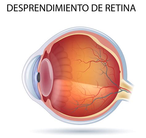 Cerclaje Dr Luis Carmona Oftalmólogo en Delicias