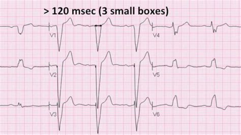 Left Bundle Branch Block Ecg