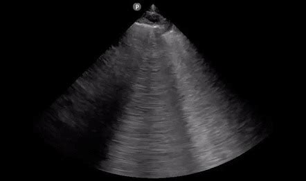 Pulmonary Edema Ultrasound