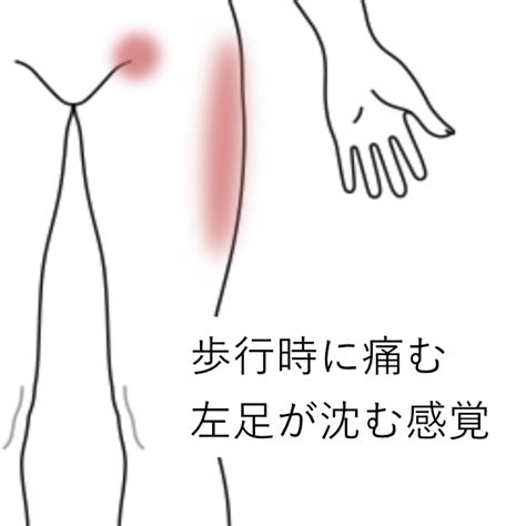 歩く時に左の鼠蹊部から太ももの外側までが痛む｜大腿の痛み、鼠径部痛・恥骨痛のツボ｜ツボネット 鍼灸の症例が検索できるツボ辞典