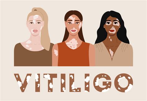 Vitiligo Vad är vitiligo och vilka är dess orsaker och symtom När