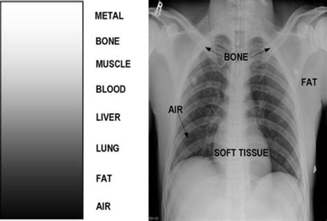 Chest X Ray Normal And Abnormal Flashcards Quizlet