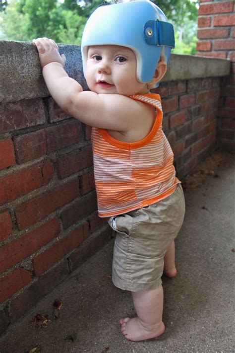 28 best images about Plagiocephaly on Pinterest | 12 weeks, Medical and ...